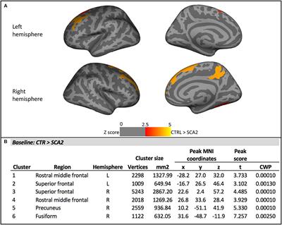 Progression of Cerebellar Atrophy in Spinocerebellar Ataxia Type 2 Gene Carriers: A Longitudinal MRI Study in Preclinical and Early Disease Stages